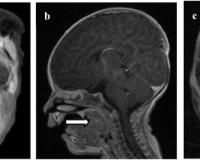 ପେଟରେ ମସ୍ତିଷ୍କର ଅଂଶ