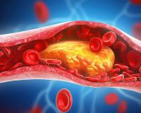 କୋଲେଷ୍ଟ୍ରଲ ବଢିବାର ଲକ୍ଷଣ