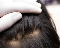 ଉକୁଣୀ ନେଲା ଛାତ୍ରୀଙ୍କ ଜୀବନ 