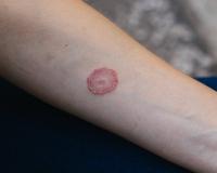 ରିଂ ୱାର୍ମ